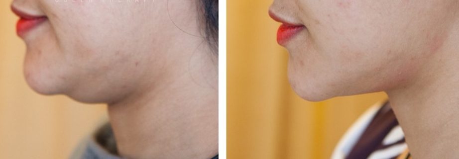 Jak pozbyć się podwójnego podbródka?