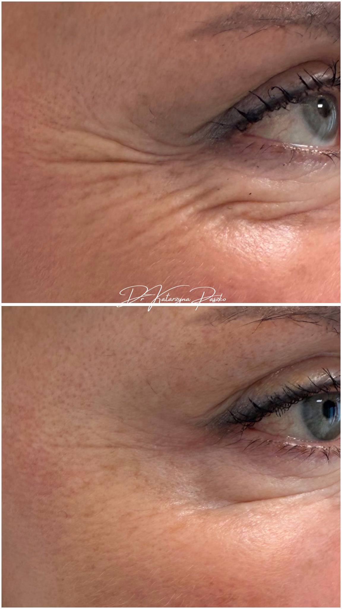 Botoks na kurze łapki — dla kogo, kiedy i co wpływa na trwałość efektów